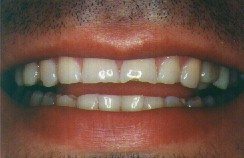 Fig. 5. Based on the evidence of the patient's occlusal pattern, this tooth broke due to excessive occlusal force generated by tooth grinding.