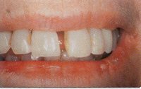 Fig. 15 Excessive force that moves teeth faster than the periodontal ligaments can respond can cause teeth to loosen.